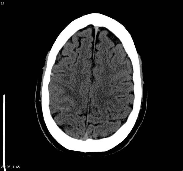 File:Cerebral vein thrombosis (Radiopaedia 4408-6628 Axial non-contrast 2).jpg