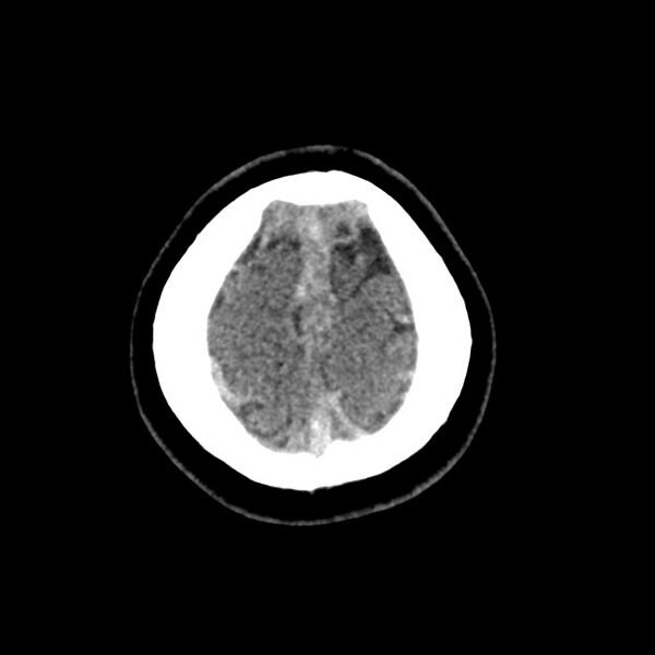 File:Cerebral venous sinus thrombosis (Radiopaedia 59224-66551 Axial non-contrast 53).jpg