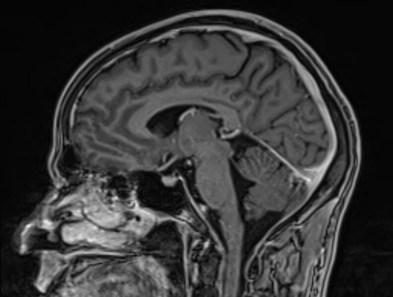 File:Cerebral venous thrombosis (Radiopaedia 71207-81504 Sagittal T1 C+ 29).jpg