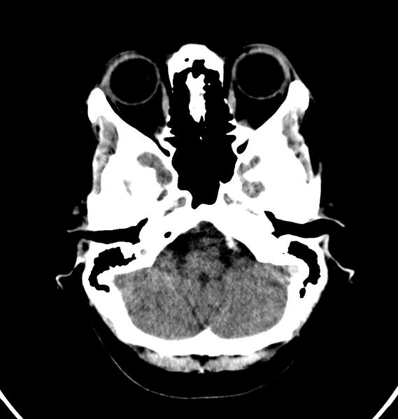 File:Cerebral venous thrombosis - CT only (Radiopaedia 41031-43778 Axial non-contrast 71).jpg