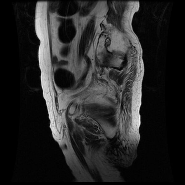 File:Cervical carcinoma (Radiopaedia 78847-91705 Sagittal T2 14).jpg