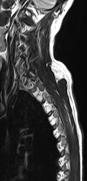 File:Cervical compressive myelopathy (Radiopaedia 71956-82411 Sagittal T2 2).jpg
