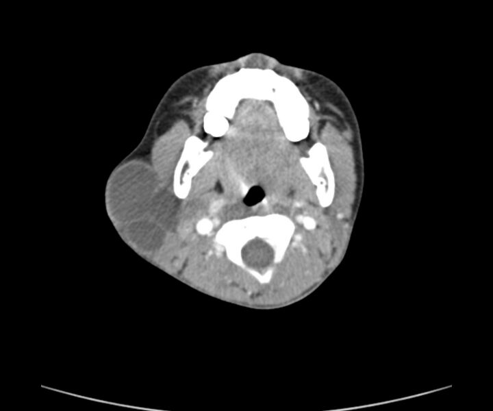 File:Cervical cystic lymphangioma (Radiopaedia 63655-72332 Axial + contrast 9).jpg