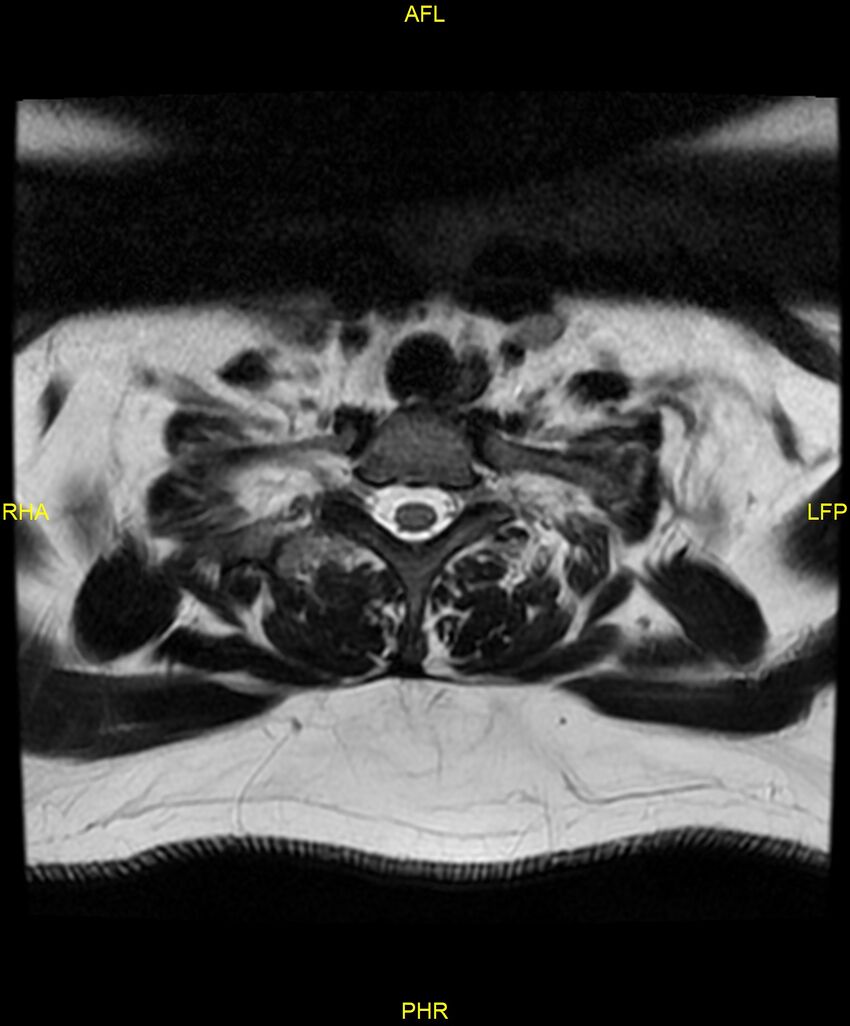Cervical disc protrusion (Radiopaedia 87147-103415 Axial T2 76).jpg