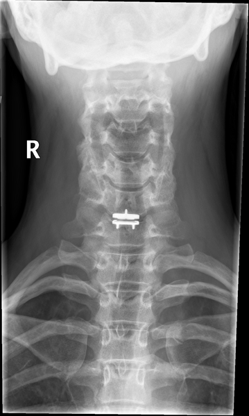 File:Cervical disc replacement (Radiopaedia 37383-39204 Frontal 1).png