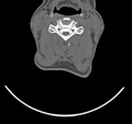 Cervical dural CSF leak on MRI and CT treated by blood patch (Radiopaedia 49748-54996 B 30).png