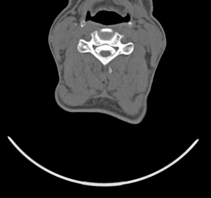 Cervical dural CSF leak on MRI and CT treated by blood patch (Radiopaedia 49748-54996 B 30).png