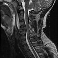 Cervical flexion teardrop fracture with cord hemorrhage (Radiopaedia 32497-33455 Sagittal T2 9).jpg