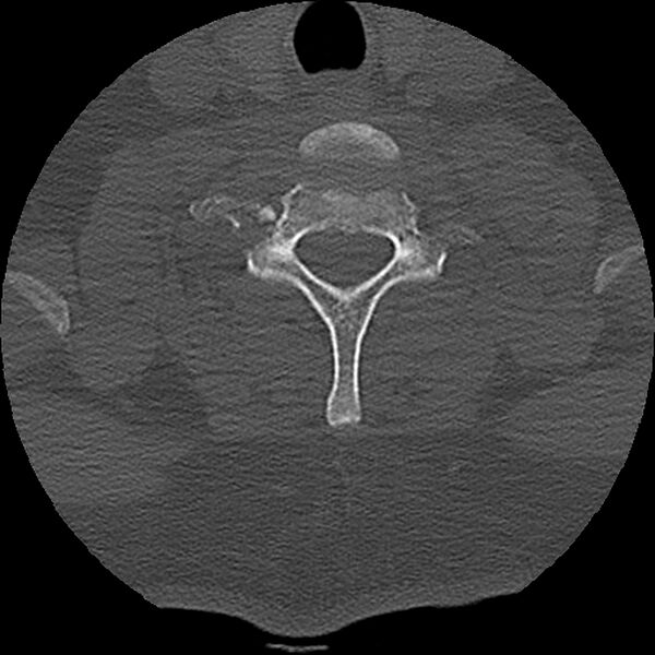 File:Cervical fracture and dislocation with locked facet (Radiopaedia 31837-32780 Axial bone window 15).jpg