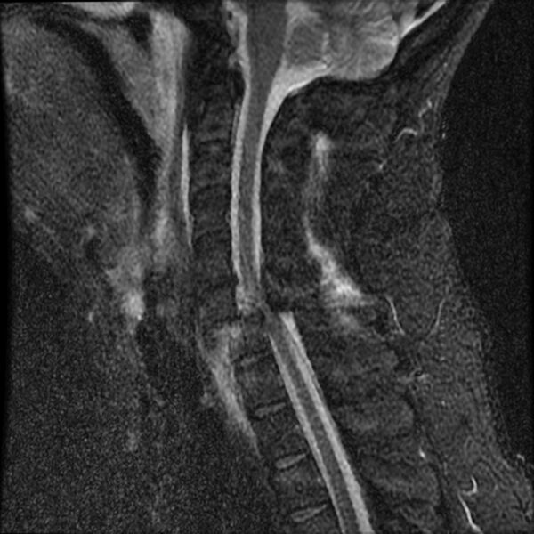 File:Cervical fracture and dislocation with locked facet (Radiopaedia 31837-32781 Sagittal STIR 10).jpg