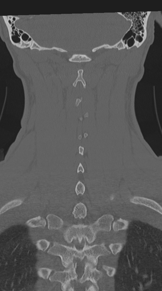 File:Cervical intercalary bone (Radiopaedia 35211-36748 Coronal bone window 59).png