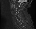 Cervical schwannoma (Radiopaedia 72399-82934 Sagittal STIR 11).jpg