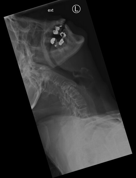 File:Cervical spine dynamic instability in patient with rheumatoid arthritis (Radiopaedia 45107-49087 Extension 1).jpg