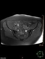 Cesarian scar endometriosis (Radiopaedia 68495-78066 Axial T1 fat sat 6).jpg