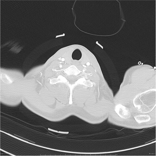 File:Chest and abdomen multi-trauma (Radiopaedia 26294-26425 lung window 5).jpg