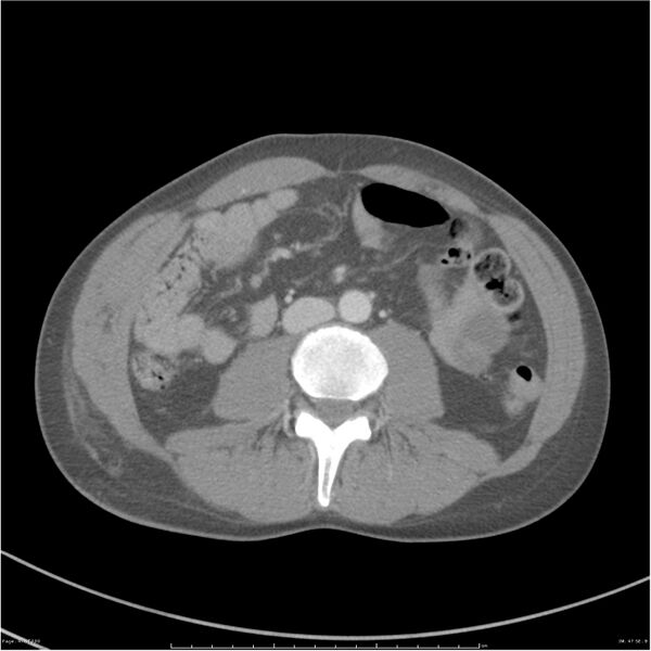 File:Chest and abdomen multi-trauma (Radiopaedia 26294-26426 A 47).jpg