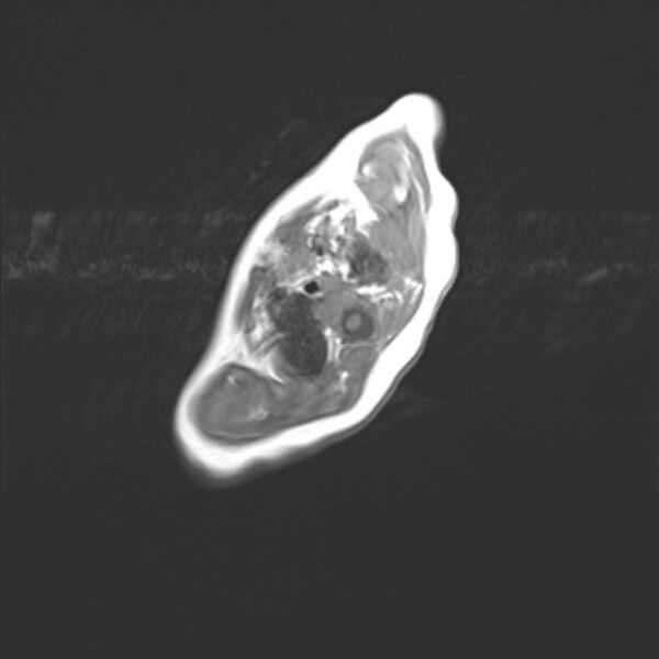 File:Chiari III malformation with occipital encephalocele (Radiopaedia 79446-92559 Axial T1 1).jpg