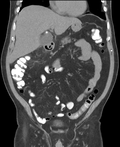 File:Cholecystitis with focal perforation and hepatic abscess (Radiopaedia 37189-38945 Coronal non-contrast 22).png