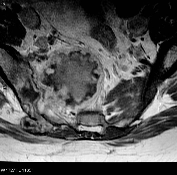 File:Chondrosarcoma - sacrum (Radiopaedia 6173-7627 Axial T1 C+ 4).jpg
