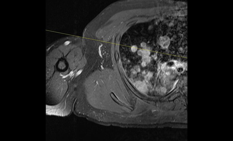 File:Choriocarcinoma in the shoulder (Radiopaedia 28603-28861 Axial T1 C+ fat sat 26).jpg