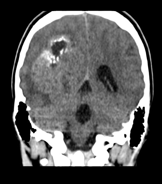 File:Choroid plexus carcinoma (Radiopaedia 91013-108552 Coronal non-contrast 58).jpg