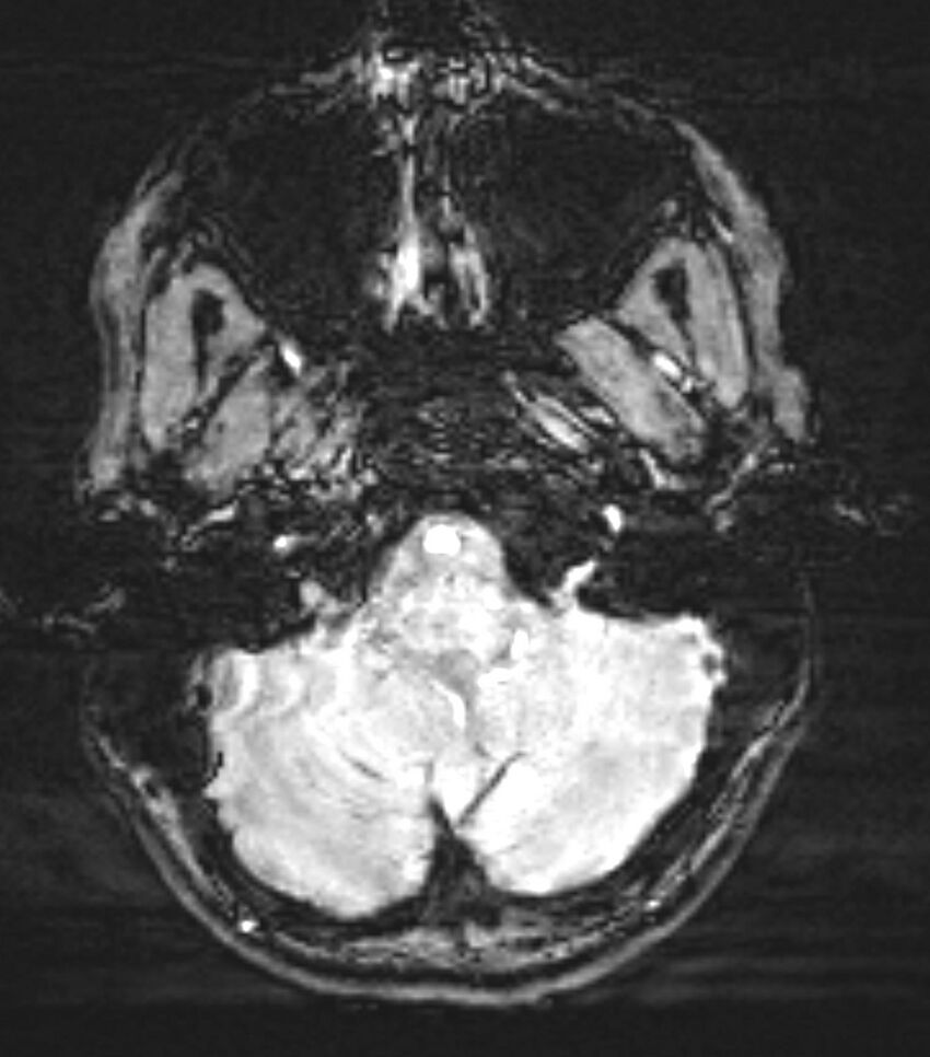 Choroid plexus carcinoma (Radiopaedia 91013-108553 Axial SWI 16).jpg