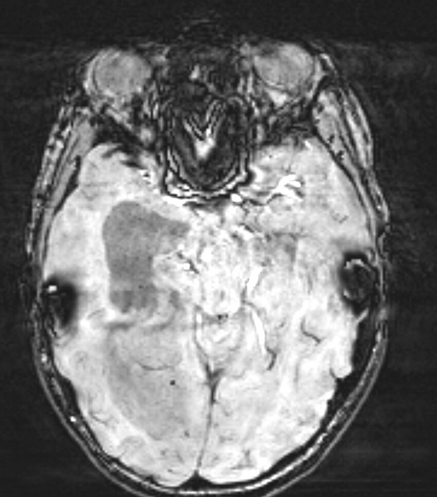 Choroid plexus carcinoma (Radiopaedia 91013-108553 Axial SWI 38).jpg