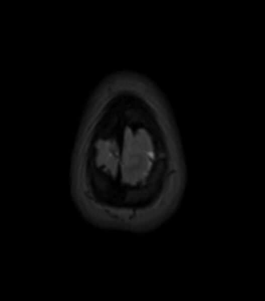 File:Choroid plexus carcinoma (Radiopaedia 91013-108553 Axial T2 fat sat 154).jpg