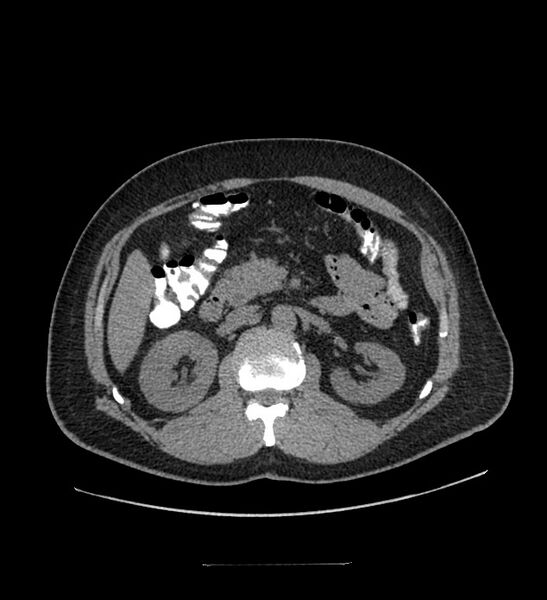 File:Chromophobe renal cell carcinoma (Radiopaedia 84337-99644 Axial non-contrast 39).jpg