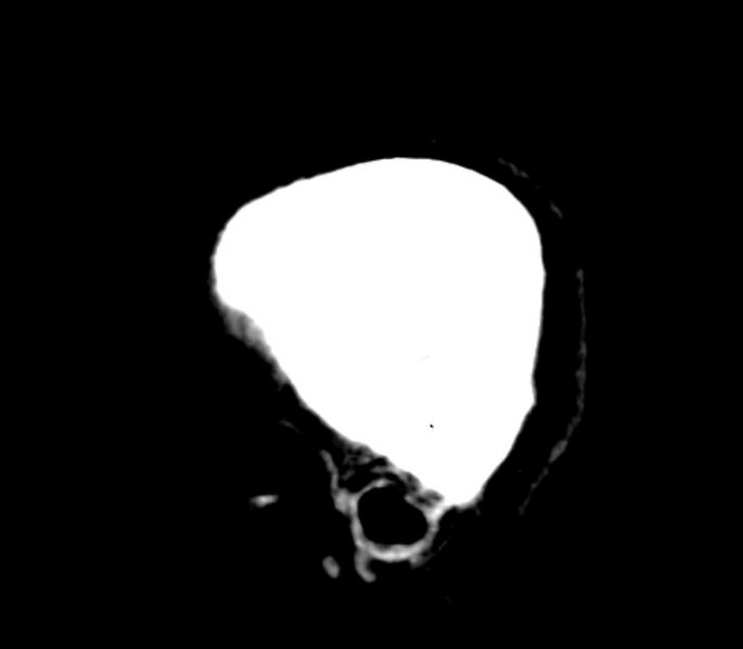 File:Chronic bilateral occipital lobe infarcts (Radiopaedia 31276-31996 C 5).jpg