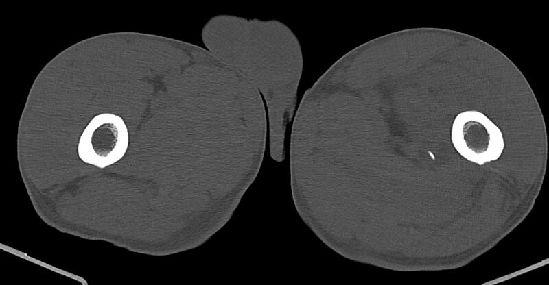File:Chronic osteomyelitis (with sequestrum) (Radiopaedia 74813-85822 Axial non-contrast 71).jpg