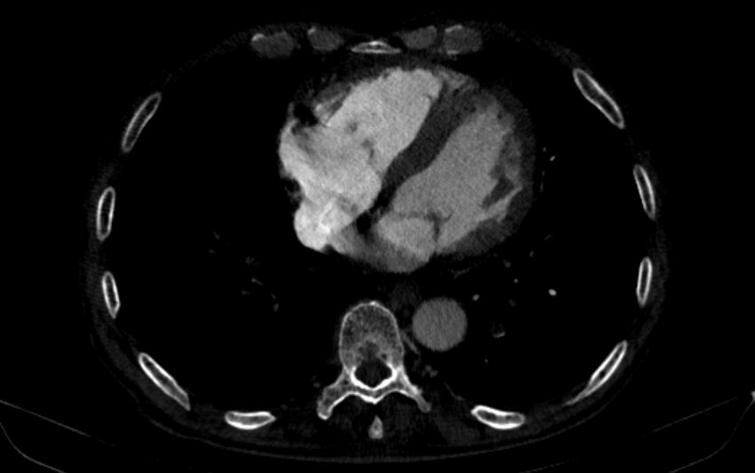Chronic pulmonary embolism (Radiopaedia 91241-108843 B 133).jpg