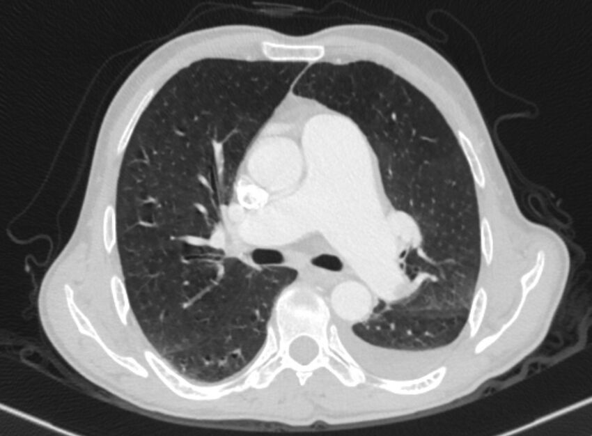 Chronic pulmonary embolism with bubbly consolidation (Radiopaedia 91248-108850 Axial lung window 73).jpg