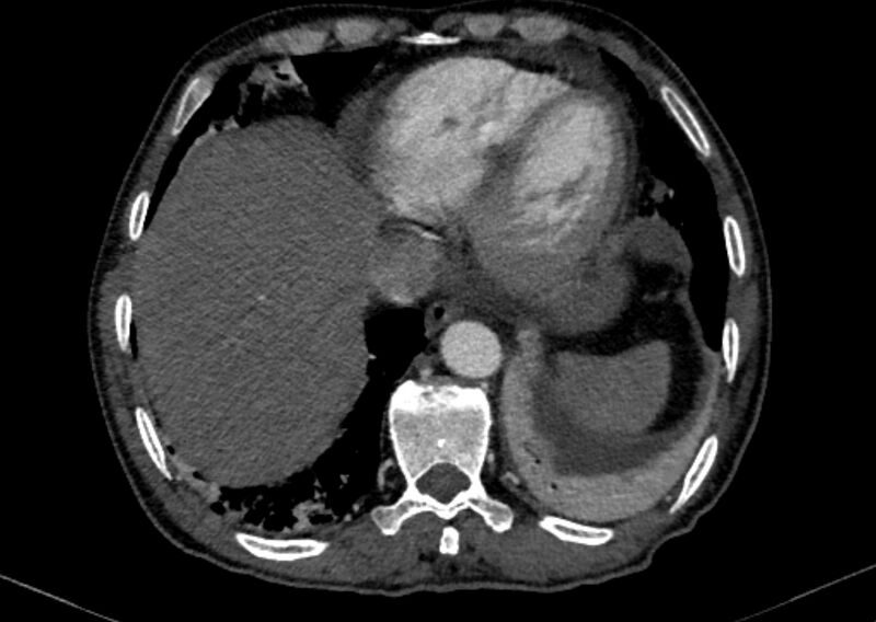 File:Chronic pulmonary embolism with bubbly consolidation (Radiopaedia 91248-108850 C+ arterial phase 122).jpg