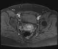 Class II Mullerian duct anomaly- unicornuate uterus with rudimentary horn and non-communicating cavity (Radiopaedia 39441-41755 Axial T1 fat sat 86).jpg