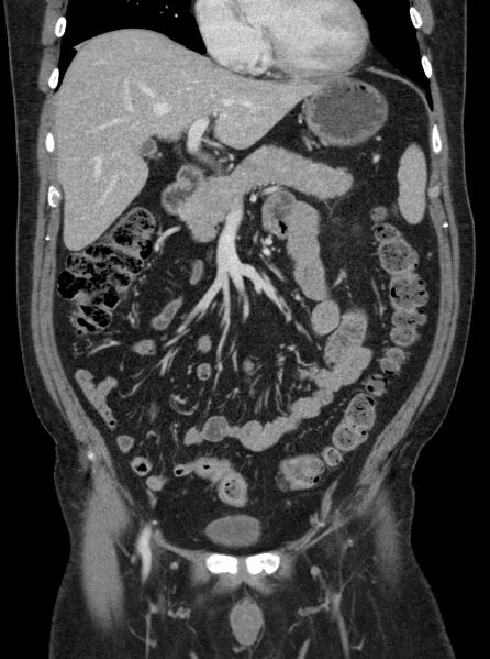 File:Clear cell renal cell carcinoma (Radiopaedia 61449-69393 F 1).jpg