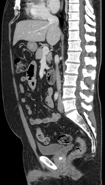 File:Clear cell renal cell carcinoma (Radiopaedia 61449-69393 G 59).jpg