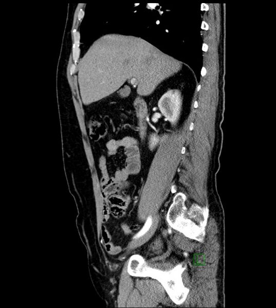 File:Clear cell renal cell carcinoma (Radiopaedia 85006-100539 E 40).jpg