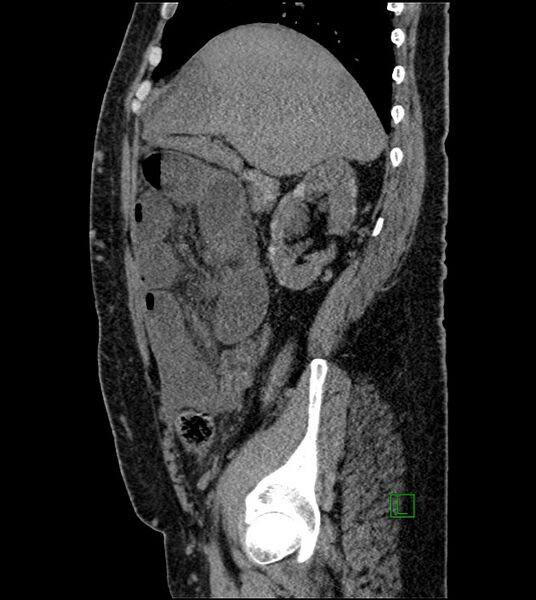 File:Closed-loop small bowel obstruction-internal hernia (Radiopaedia 78439-91096 C 103).jpg