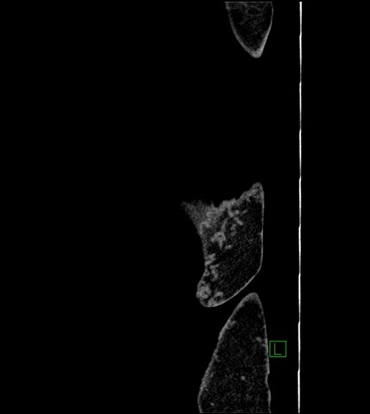 File:Closed-loop small bowel obstruction-internal hernia (Radiopaedia 78439-91096 C 3).jpg