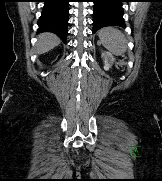 File:Closed-loop small bowel obstruction-internal hernia (Radiopaedia 78439-91096 Coronal non-contrast 84).jpg