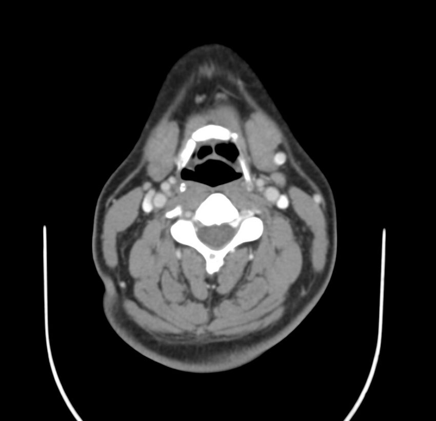 Colloid cyst of thyroid (Radiopaedia 22897-22923 Axial C+ delayed 38).jpg