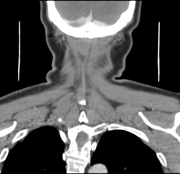 File:Colloid cyst of thyroid (Radiopaedia 22897-22923 Coronal C+ delayed 55).jpg