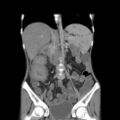Colocolic fistula - Crohn disease (Radiopaedia 57063-63955 B 22).jpg