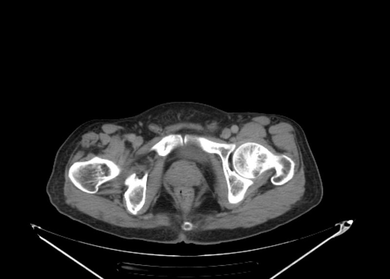 File:Colon cancer mimicking renal cell carcinoma (Radiopaedia 28986-29335 Axial C+ delayed 78).jpg