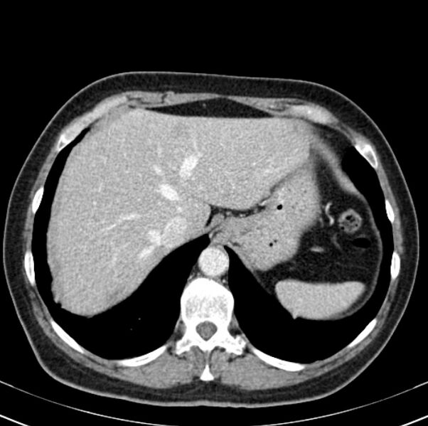 File:Colon carcinoma with hepatic metastases (Radiopaedia 29477-29961 A 17).jpg