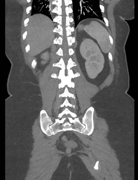 File:Colonic pseudo-obstruction (Radiopaedia 79752-92980 B 47).png