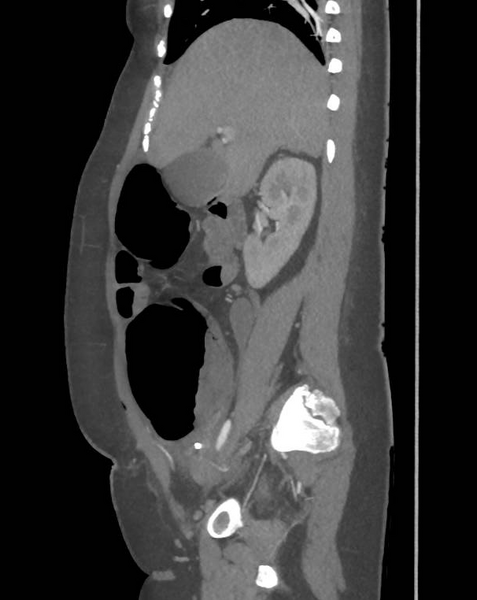 File:Colonic pseudo-obstruction (Radiopaedia 79752-92980 C 29).png