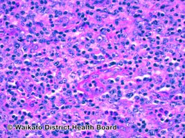 Angioimmunoblastic T-cell lymphoma-pathology