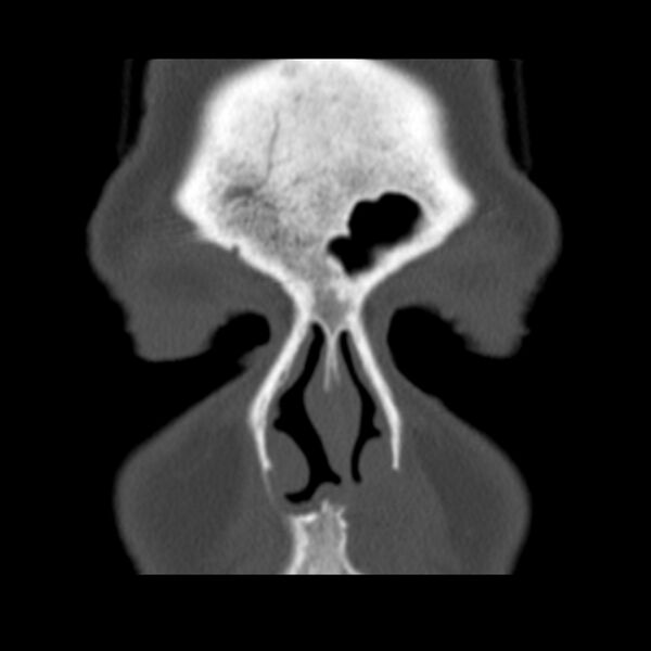 File:Nasolabial cyst (Radiopaedia 33987-35205 Coronal bone window 22).jpg